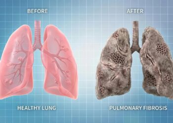 Sağlıklı akciğer ile pulmoner fibrozis nedeniyle hasar görmüş akciğerlerin kıyaslandığı tıbbi çizim.